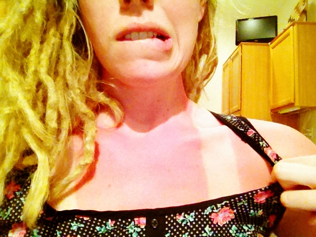 Thank You for Noticing My Sunburn